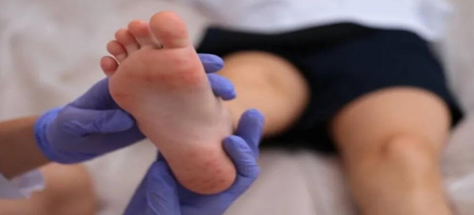 Cancelan clases por Brote de coxsackie en Tlaxcala