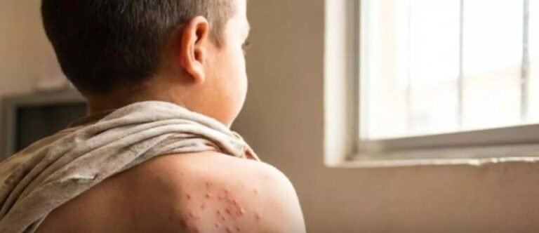 Mantienen bajo vigilancia a 70 personas por posible brote de sarampión en Tlaxcala