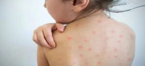 Confirman tercer caso positivo de sarampión en Tlaxcala