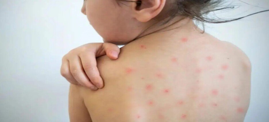 Confirman tercer caso positivo de sarampión en Tlaxcala